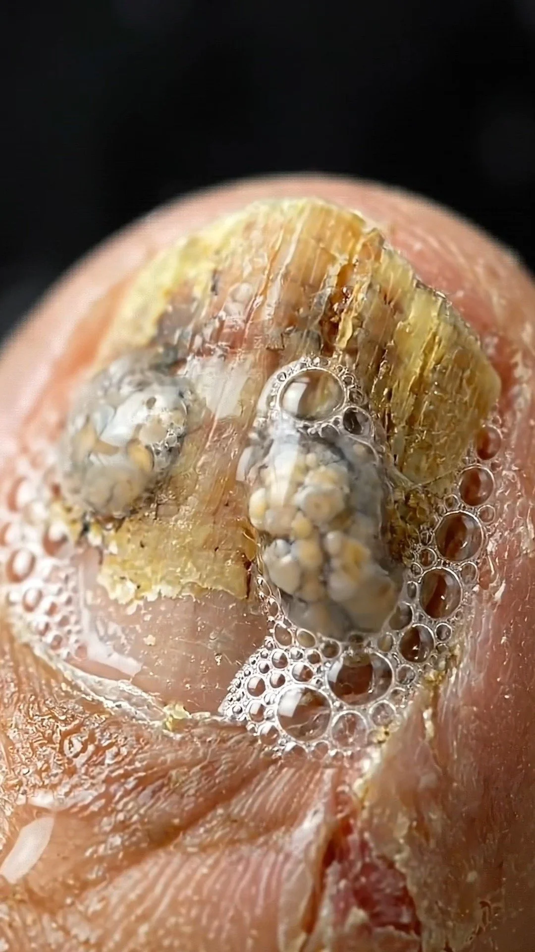 Ways to prevent worsening of fungal infections with natural remedies.